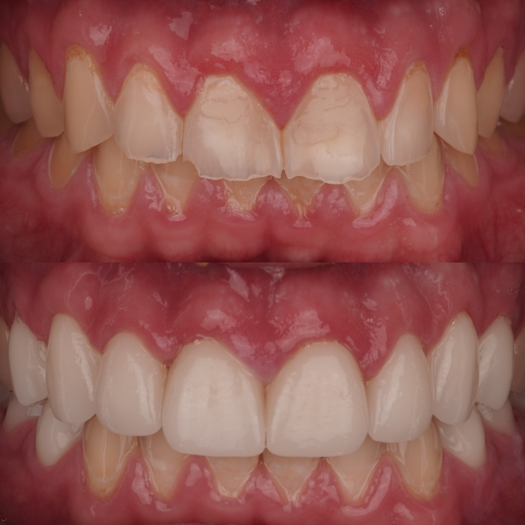Dental crowns before and after results