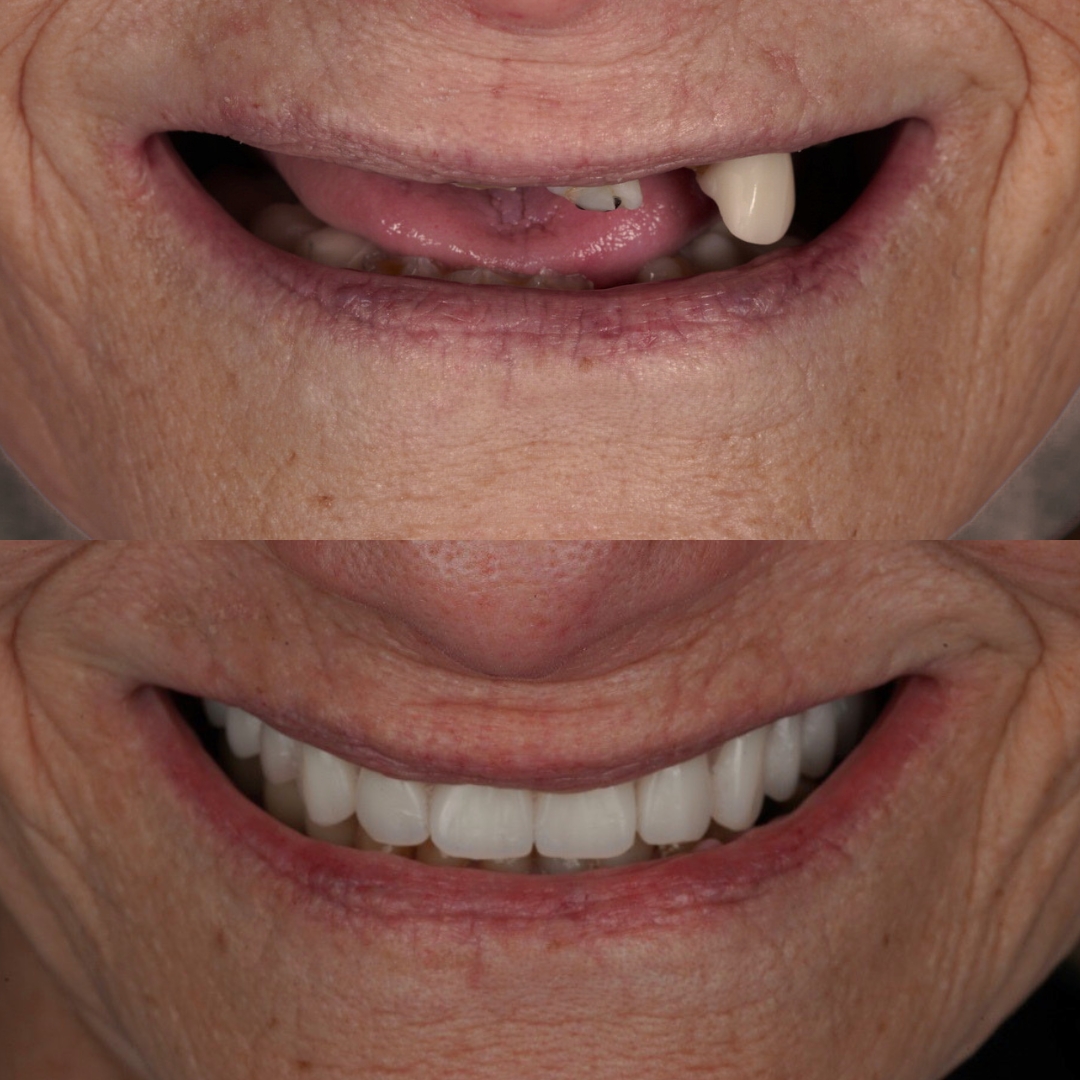 Before and after custom dentures restoring a full smile
