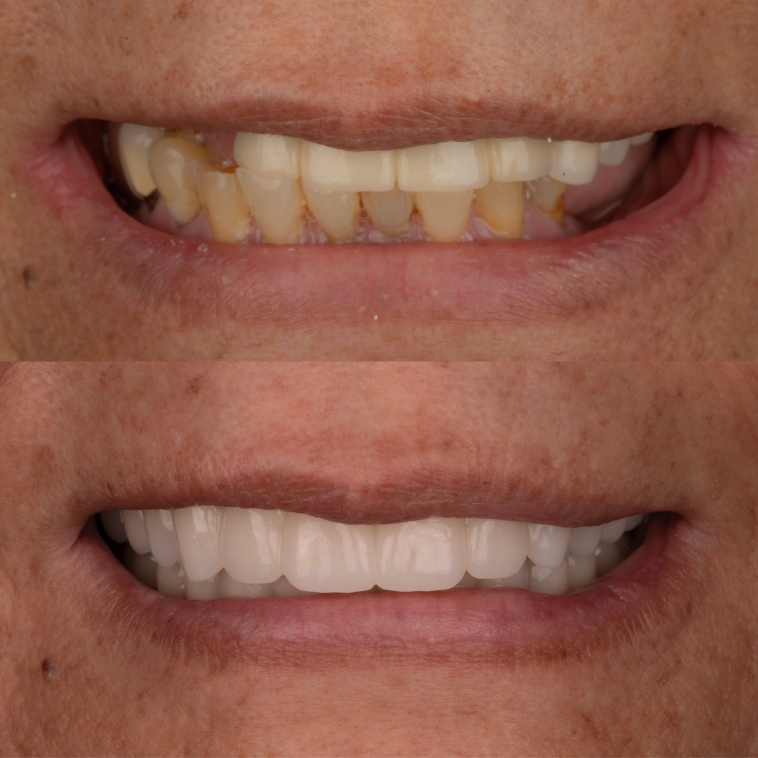 Before and after hybrid dentures for a natural-looking smile