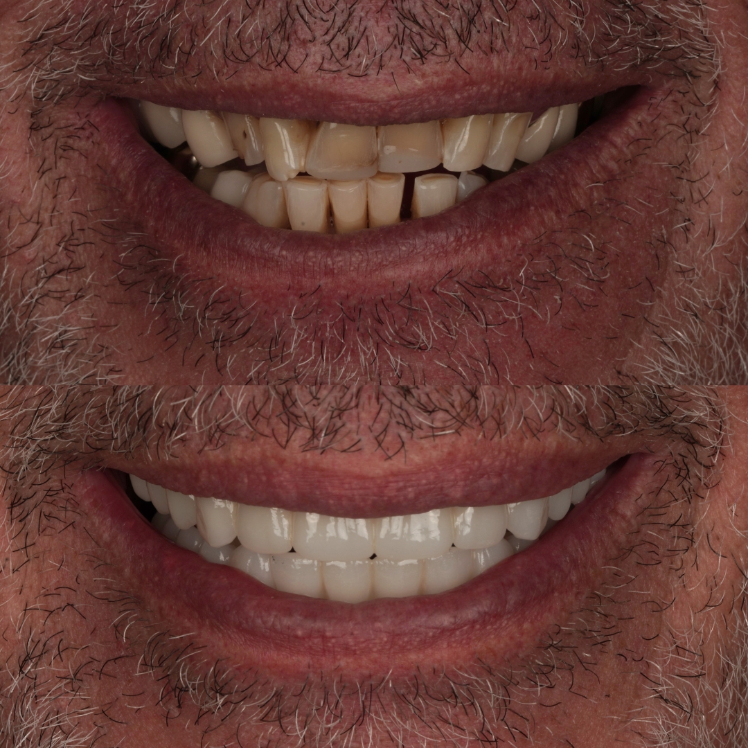 Before and after All-on-4 full arch implant restoration