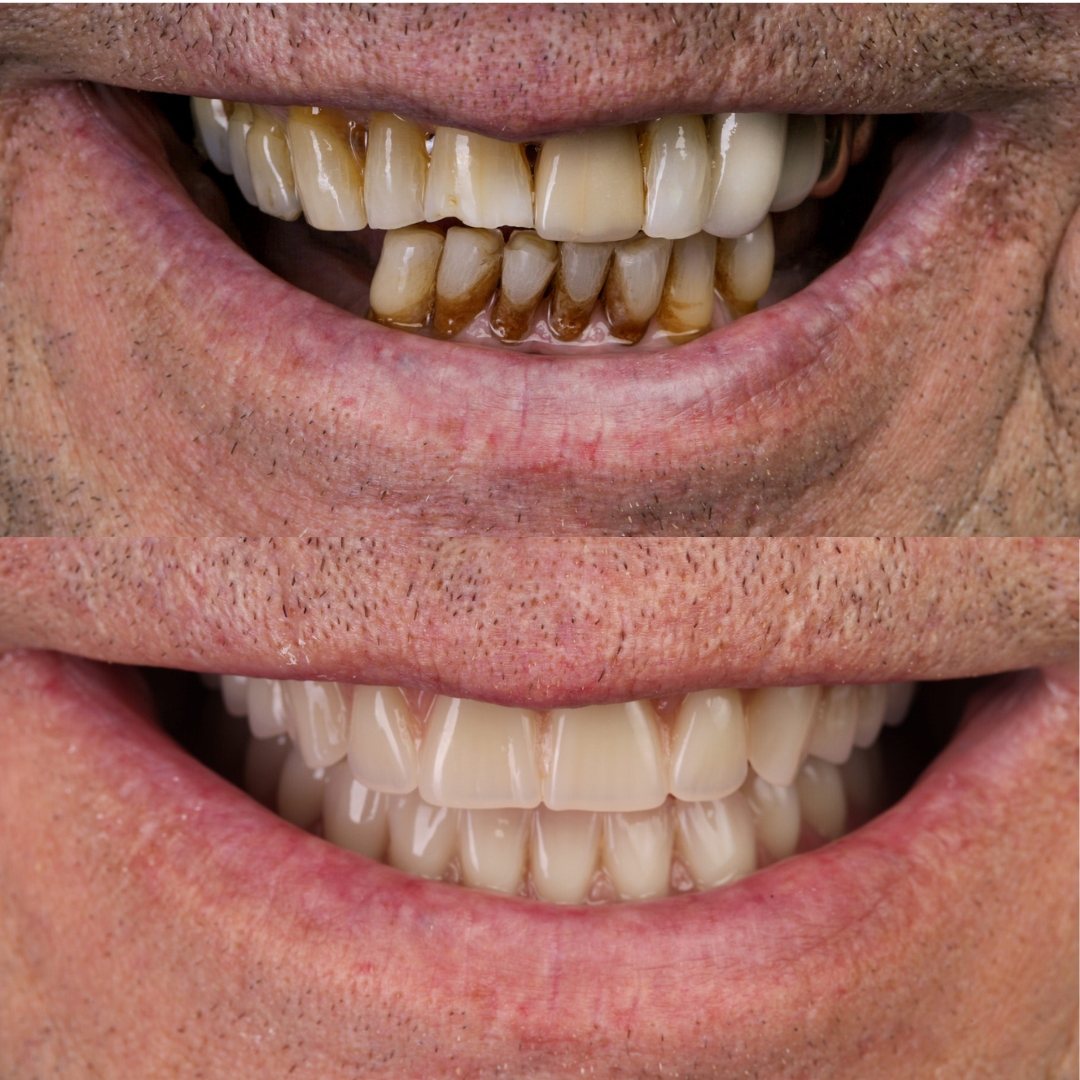 Before and after snap-in dentures for a secure fit
