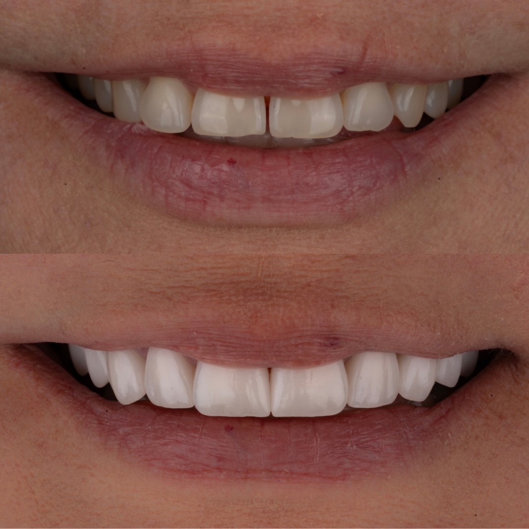 Before and after porcelain veneers smile makeover