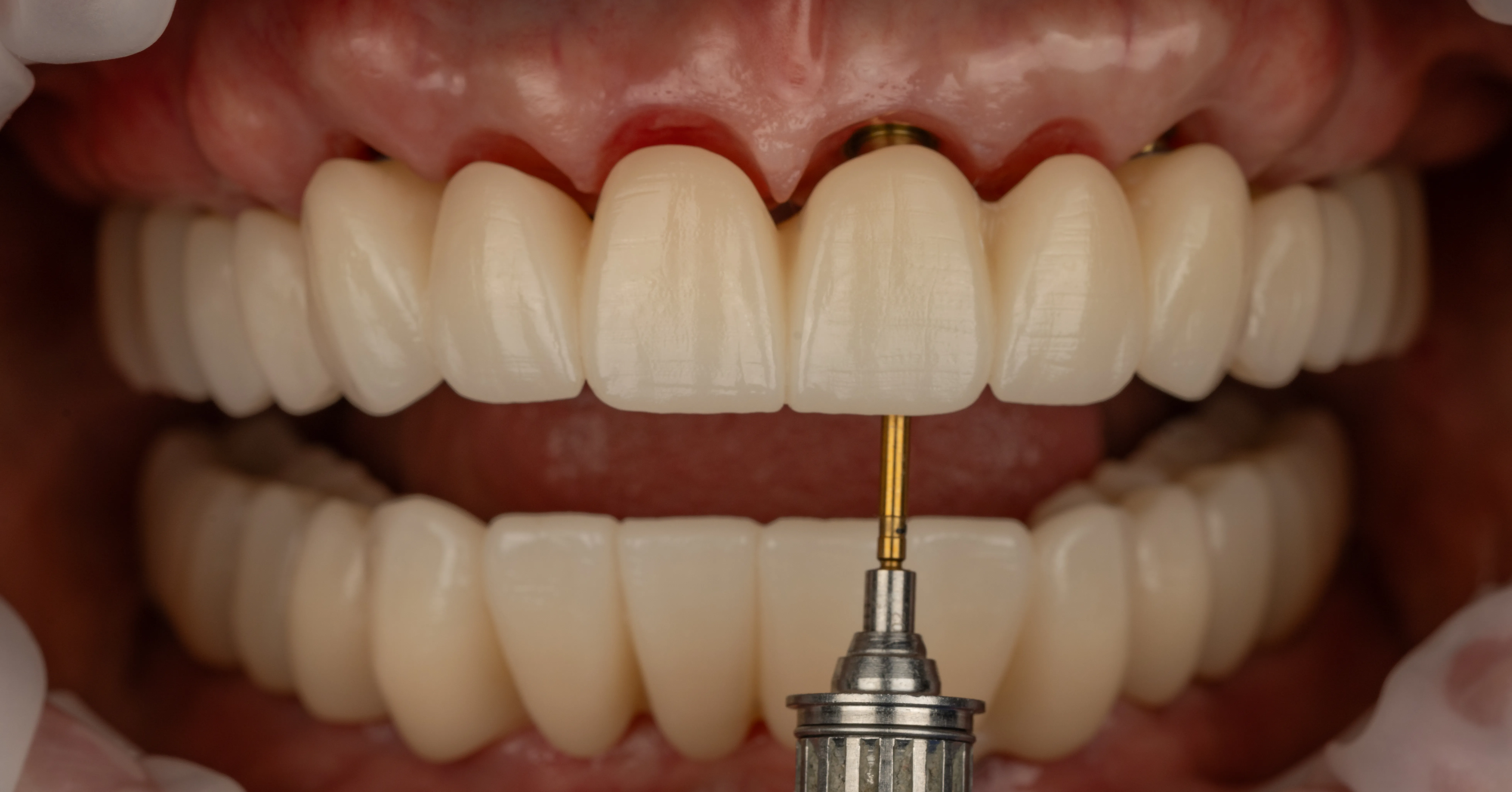 Patient smile restoration result