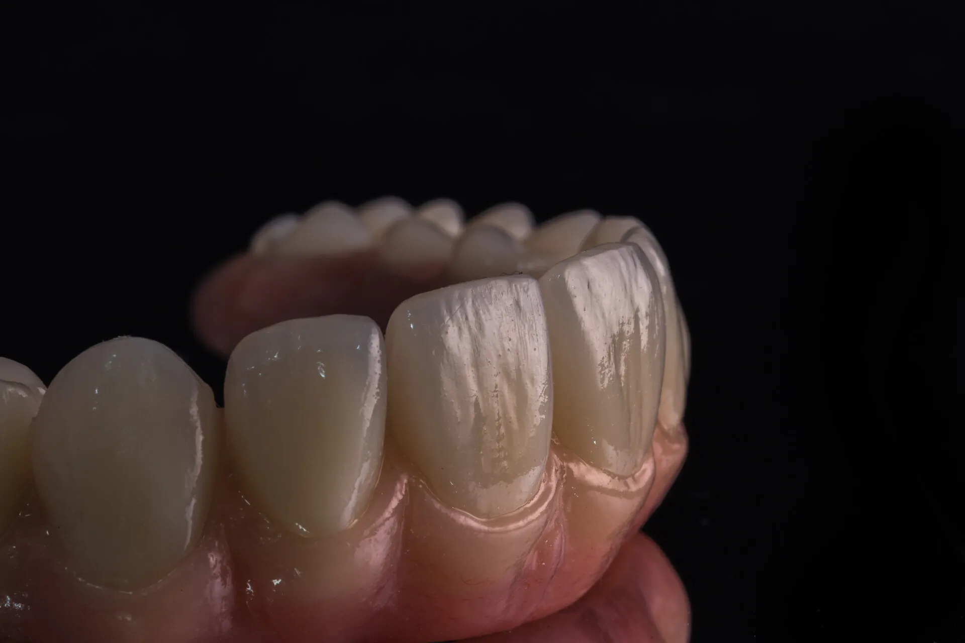 Porcelain veneers crafted with premium materials